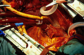 Heart bypass surgery