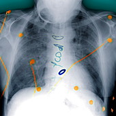 Heart surgery,X-ray