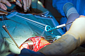 Heart valve repair surgery