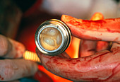 Surgeon's gloved hand holds artificial heart valve