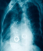 Prosthetic heart valves,X-ray