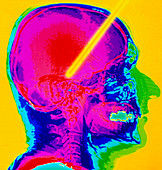 Coloured CT scan: Parkinson's disease brain probe