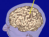 3-D MRI scan of a brain undergoing surgery