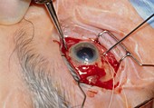 Cataract surgery: process of removing eye lens