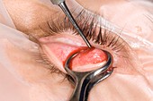 Chalazion cyst eyelid surgery