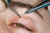 Eyelid surgery