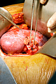 Kidney transplant