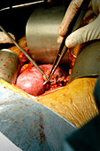 Kidney transplant