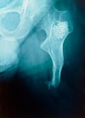 Bone graft X-ray