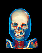 Facial reconstruction,CT scan