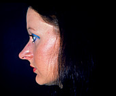 Profile of woman's face prior to cosmetic surgery