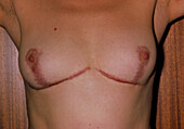 Keloid scarring after cosmetic breast surgery