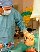 Surgeon conducts liposuction for breast reduction