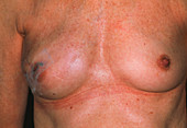 Breast reconstruction following tumour excision