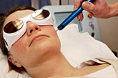 Laser wrinkle treatment