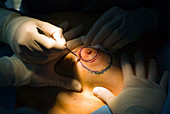 Cosmetic breast and abdominal surgery
