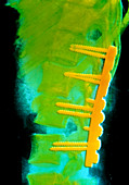 False-colour x-ray of the human spine