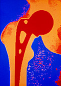 False colour x-ray of prosthetic hip joint