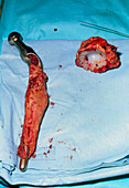 Prosthetic hip joint removed due to loosening