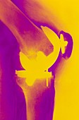 Coloured X-ray of prosthetic knee joint,side view