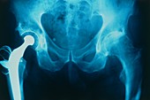 X-ray of artificial hip joint and osteoarthritis