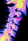 Coloured X-ray of implanted disc in cervical spine