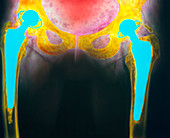 Coloured X-ray of a bilateral hip replacement
