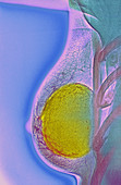 Breast implant calcification,X-ray