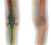 Knee replacement,X-ray