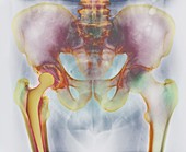 Hip replacement,X-ray