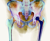 Hip joint replacement,X-ray