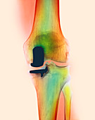 Knee joint prosthesis,X-ray