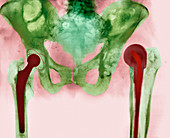 Failed hip joint replacement,X-ray