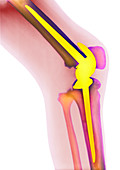 Knee replacement,X-ray