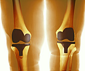 Prosthetic knee joints,X-ray