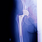 Total hip replacement,X-ray