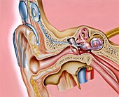 Cochlear implant,artwork