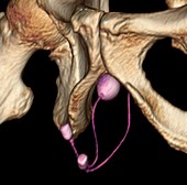 Artificial urinary sphincter,3D CT scan