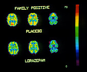 Coloured PET brain scans showing lorazepam action