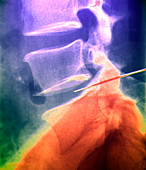 Slipped disc treatment,X-ray