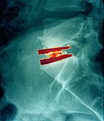 Intervertebral bone graft,X-ray