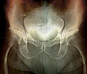 Prostate cancer treatment,X-ray