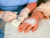 Chemotherapy: drug injected into catheter in hand