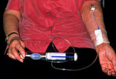 Woman using a PICC device for cancer chemotherapy