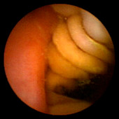 Billroth II gastrectomy,pill camera view