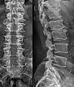 Laminectomy for spinal stenosis,X-ray