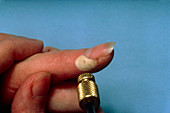 Removal of viral wart on finger