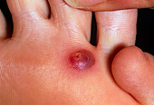 Close-up of a blister after verruca cryosurgery