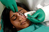 Vitiligo treatment,skin graft