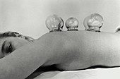 Female patient's back receiving cupping treatment